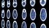 Risk Factors for Preeclampsia and Pregnancy-Associated Stroke in Women Risk Factors for Preeclampsia and Pregnancy-Associated Stroke in Women