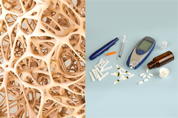 Managing Osteoporosis With Type 2 Diabetes: An Expert Opinion Managing Osteoporosis With Type 2 Diabetes: An Expert Opinion