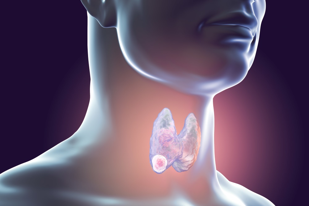 transoral-endoscopic-thyroidectomy-vestibular-approach-safety-and-outcomes