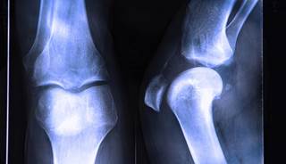 Cholecalficerol may help reduce bone mineral density loss after bariatric surgery. Cholecalficerol may help reduce bone mineral density loss after bariatric surgery.