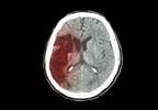 Growth Hormone Treatment May Up Stroke Risk Growth Hormone Treatment May Up Stroke Risk