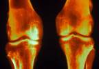 AMG 416 Succeeds in Secondary Hyperparathyroidism Trial AMG 416 Succeeds in Secondary Hyperparathyroidism Trial
