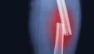Rosuvastatin Failed to Decrease Fracture Risk Rosuvastatin Failed to Decrease Fracture Risk