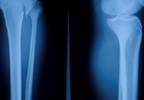 Combination Denosumab, Teriparatide Beneficial for Bone Density Combination Denosumab, Teriparatide Beneficial for Bone Density