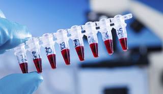 Novel Biomarker Could Improve Papillary Thyroid Cancer Monitoring Novel Biomarker Could Improve Papillary Thyroid Cancer Monitoring