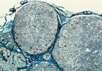 Complexities of Cushing's Syndrome Complexities of Cushing's Syndrome