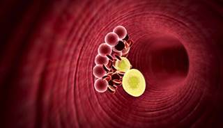 Alirocumab May Benefit Patients with Statin Intolerance Alirocumab May Benefit Patients with Statin Intolerance