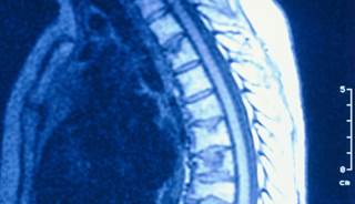 Guidelines for Paget’s Disease of the Bone Released Guidelines for Paget’s Disease of the Bone Released