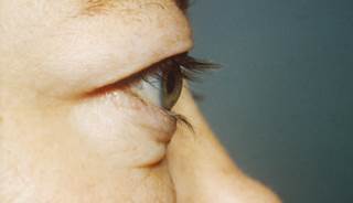 Graves' Ophthalmopathy Risk Decreased With Thyroidectomy, Statin Use Graves' Ophthalmopathy Risk Decreased With Thyroidectomy, Statin Use