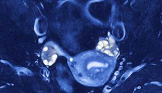 Hyperandrogenism Linked to Low BMI in Polycystic Ovary Syndrome Hyperandrogenism Linked to Low BMI in Polycystic Ovary Syndrome