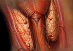 Cardiovascular Event Risk Higher With Total Parathyroidectomy Cardiovascular Event Risk Higher With Total Parathyroidectomy