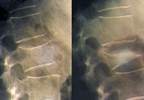 FRAME: Romosozumab Decreases Vertebral Fracture Risk in Osteoporosis FRAME: Romosozumab Decreases Vertebral Fracture Risk in Osteoporosis