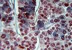 Copeptin May Be Marker for Diabetes Insipidus After Pituitary Surgery Copeptin May Be Marker for Diabetes Insipidus After Pituitary Surgery