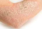 Increased Coronary Artery Calcium Seen in Psoriasis Increased Coronary Artery Calcium Seen in Psoriasis