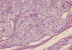 Liquid Biopsy May Help Predict Survival in Medullary Thyroid Carcinoma Liquid Biopsy May Help Predict Survival in Medullary Thyroid Carcinoma