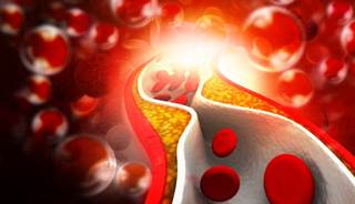 The use of PCSK9 inhibitors may not be cost-effective. The use of PCSK9 inhibitors may not be cost-effective.