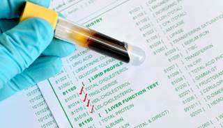Patients in midlife with normal cognition and high levels of triglycerides had more abnormal beta-amyloid markers in CSF. Patients in midlife with normal cognition and high levels of triglycerides had more abnormal beta-amyloid markers in CSF.