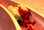 Testosterone Not Associated With Atherosclerosis in Older Men Testosterone Not Associated With Atherosclerosis in Older Men