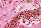 Endocrine Society Releases Guidelines on Treatment of Cushing's Syndrome Endocrine Society Releases Guidelines on Treatment of Cushing's Syndrome