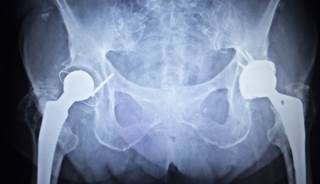 The risk for heart attack is increased after total hip or knee arthroplasty. The risk for heart attack is increased after total hip or knee arthroplasty.