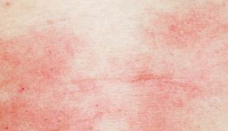 Type 1 diabetes in childhood is associated with a higher risk for atopic dermatitis. Type 1 diabetes in childhood is associated with a higher risk for atopic dermatitis.