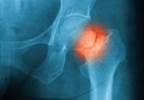 Trabecular Bone Score, HbA1c May Predict Fractures in Type 1 Diabetes Trabecular Bone Score, HbA1c May Predict Fractures in Type 1 Diabetes