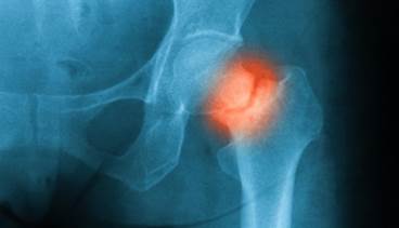 Trabecular Bone Score, HbA1c May Predict Fractures in Type 1 Diabetes Trabecular Bone Score, HbA1c May Predict Fractures in Type 1 Diabetes
