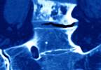 Abaloparatide Decreased Fractures in Postmenopausal Women With Osteoporosis Abaloparatide Decreased Fractures in Postmenopausal Women With Osteoporosis