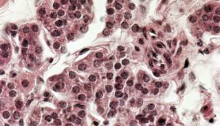 Parathyroidectomy may be more effective than cinacalcet for kidney transplant patients with hyperparathyroidism. Parathyroidectomy may be more effective than cinacalcet for kidney transplant patients with hyperparathyroidism.