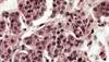 Cerebrovascular Dysfunction May Affect Cognition in Primary Hyperparathyroidism Cerebrovascular Dysfunction May Affect Cognition in Primary Hyperparathyroidism