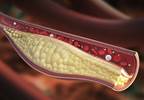 Predictors of Atherosclerosis Progression in African Americans With Type 2 Diabetes Predictors of Atherosclerosis Progression in African Americans With Type 2 Diabetes
