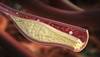 Predictors of Atherosclerosis Progression in African Americans With Type 2 Diabetes Predictors of Atherosclerosis Progression in African Americans With Type 2 Diabetes