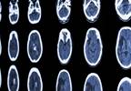 Risk Factors for Preeclampsia and Pregnancy-Associated Stroke in Women Risk Factors for Preeclampsia and Pregnancy-Associated Stroke in Women