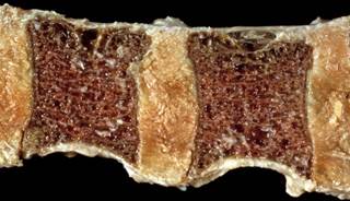 Patients with psoriatic arthritis or psoriasis had an increased prevalence of osteoporosis risk factors.http://www.endocrinologyadvisor.com/bone-metabolism/fracture-risk-in-adults-with-hypertension/ar Patients with psoriatic arthritis or psoriasis had an increased prevalence of osteoporosis risk factors.http://www.endocrinologyadvisor.com/bone-metabolism/fracture-risk-in-adults-with-hypertension/ar