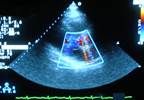 Imaging to Prevent Heart Failure in Asymptomatic Type 2 Diabetes Patients May Be Cost-Saving Imaging to Prevent Heart Failure in Asymptomatic Type 2 Diabetes Patients May Be Cost-Saving