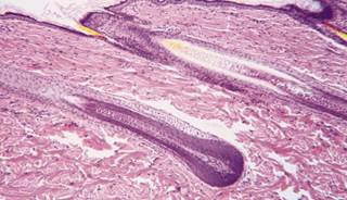 Researchers found serum and tissue vitamin D receptor levels in patients with alopecia. Researchers found serum and tissue vitamin D receptor levels in patients with alopecia.