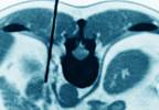 Diabetes Risk Higher With 'Nonfunctional' Adrenal Tumors Diabetes Risk Higher With 'Nonfunctional' Adrenal Tumors
