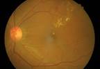 One-Hour Plasma Glucose Useful Predictor of Diabetic Retinopathy One-Hour Plasma Glucose Useful Predictor of Diabetic Retinopathy