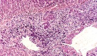 Left adrenal vein aldosterone ratio may identify right-sided unilateral disease. Left adrenal vein aldosterone ratio may identify right-sided unilateral disease.