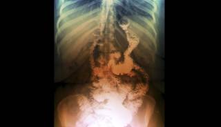 Gastric bypass was linked to reduced symptoms and neurohormonal responses to hypoglycemia. Gastric bypass was linked to reduced symptoms and neurohormonal responses to hypoglycemia.