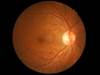 Diabetic Retinopathy Screening Should Be Individualized Based on Eye Health, Glycated Hemoglobin Diabetic Retinopathy Screening Should Be Individualized Based on Eye Health, Glycated Hemoglobin