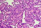 Sequential Combination Strategy May Be Optimal in Advanced Thyroid Cancer Sequential Combination Strategy May Be Optimal in Advanced Thyroid Cancer