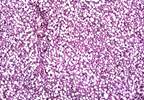 Reviewing Treatment for Nonalcoholic Fatty Liver Disease Reviewing Treatment for Nonalcoholic Fatty Liver Disease