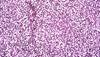 Liraglutide, Metformin, and Gliclazide Compared in Comorbid Type 2 Diabetes and Nonalcoholic Fatty Liver Disease Liraglutide, Metformin, and Gliclazide Compared in Comorbid Type 2 Diabetes and Nonalcoholic Fatty Liver Disease