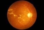 CPAP for OSA Does Not Improve Diabetic Macular Edema or Visual Acuity CPAP for OSA Does Not Improve Diabetic Macular Edema or Visual Acuity