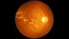 CPAP for OSA Does Not Improve Diabetic Macular Edema or Visual Acuity CPAP for OSA Does Not Improve Diabetic Macular Edema or Visual Acuity