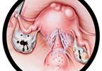 Elagolix Relieves Short-Term Menstrual Pain, Dysmenorrhea in Endometriosis Elagolix Relieves Short-Term Menstrual Pain, Dysmenorrhea in Endometriosis