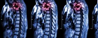 Less frequent dosing with zoledronic acid does not increase fracture risk in patients with bone metastases. Less frequent dosing with zoledronic acid does not increase fracture risk in patients with bone metastases.