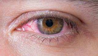 Diabetes is associated with an increased incidence of conjunctivitis. Diabetes is associated with an increased incidence of conjunctivitis.