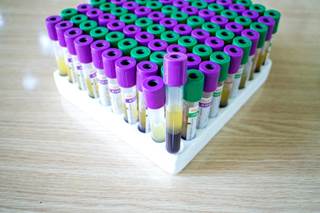 The accuracy of the tests used to detect prediabetes in screening programs is low. The accuracy of the tests used to detect prediabetes in screening programs is low.